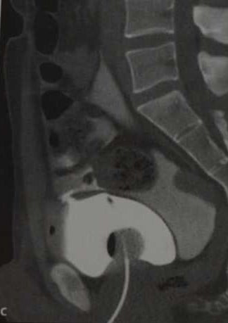 Снимки МРТ и КТ. Разрыв мочевого пузыря