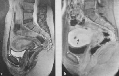Снимки МРТ и КТ. Полипы эндометрия