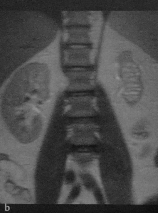 Снимки МРТ и КТ. Хронический пиелонефрит