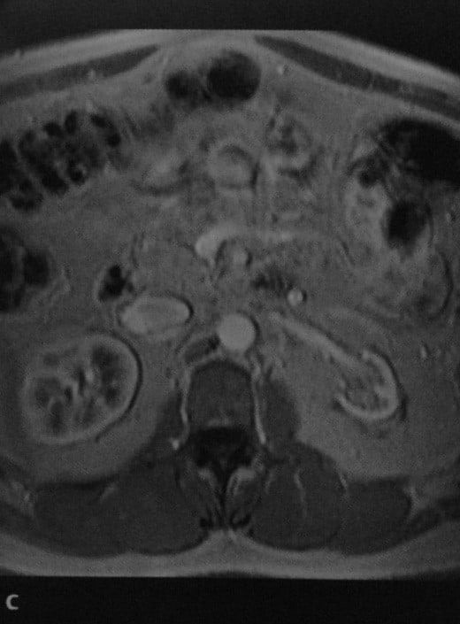 Снимки МРТ и КТ. Хронический пиелонефрит