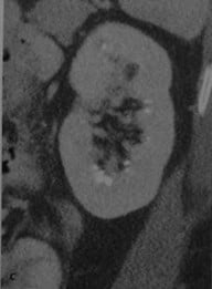 Снимки МРТ и КТ. Медуллярная губчатая почка