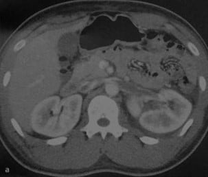 Снимки МРТ и КТ. Тромбоз почечной вены