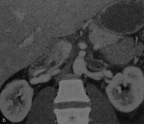 Снимки МРТ и КТ. Тромбоз почечной вены