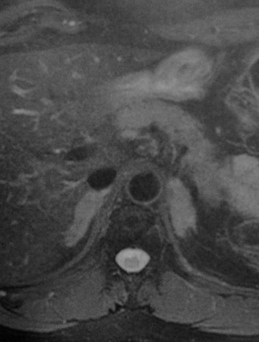 Снимки МРТ и КТ. Адренокортикальная гиперплазия