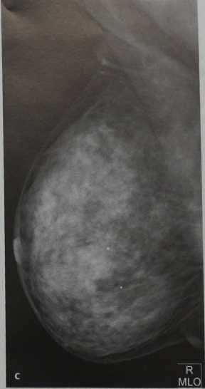 Снимки МРТ и КТ. маммография, медиолатеральная проекция