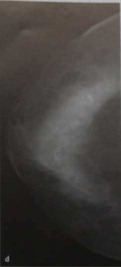 Снимки МРТ и КТ. Плеоморфные микрокальцинаты