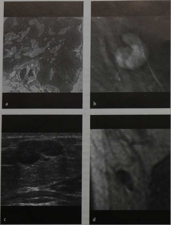 Снимки МРТ и КТ. Подмышечные лимфатические узлы