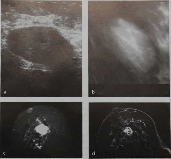 Снимки МРТ и КТ. Листовидная опухоль