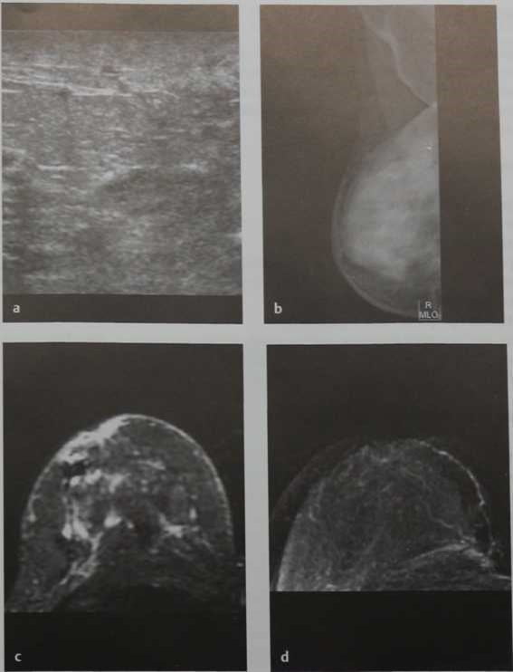 Снимки МРТ и КТ. Изменения после лучевой терапии