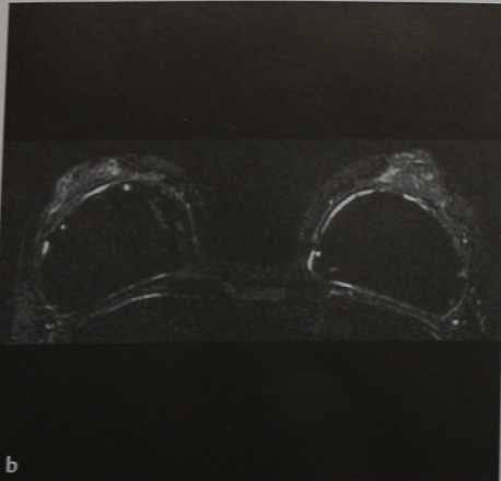 Снимки МРТ и КТ. Импланты молочных желез