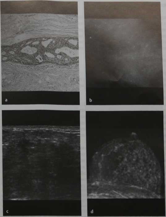 Снимки МРТ и КТ. Протоковый рак in situ низкой градации