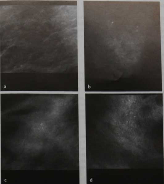 Снимки МРТ и КТ. Протоковый рак in situ промежуточной градации