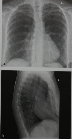 Снимки МРТ и КТ. Воронкообразная грудь