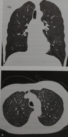 Снимки МРТ и КТ. Респираторный бронхиолит 