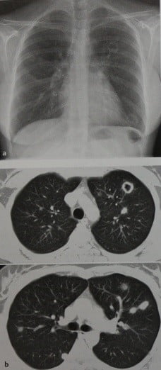 Снимки МРТ и КТ. Гранулематоз Вегенера грудная клетка