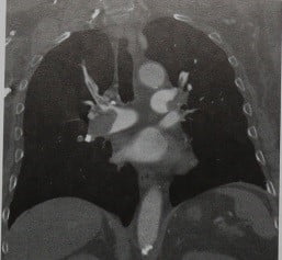 Снимки МРТ и КТ. Тромбоэмболия легочной артерии
