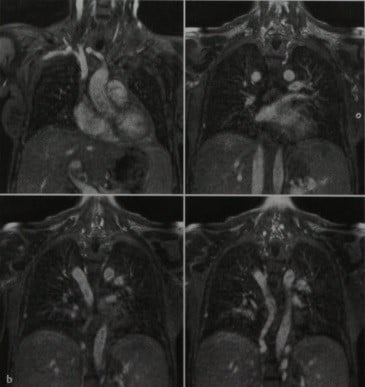 Снимки МРТ и КТ. Расширение непарной вены