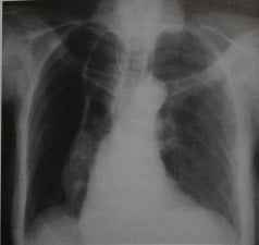Снимки МРТ и КТ. Ахалазия кардии