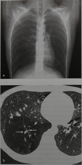Снимки МРТ и КТ. Атрезия бронха