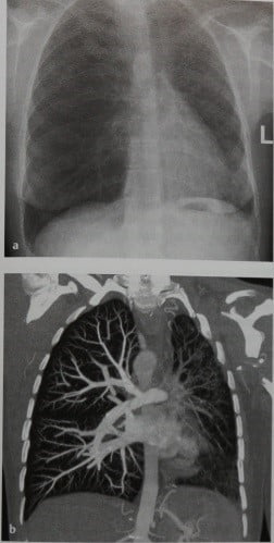 Снимки МРТ и КТ. Гипоплазия и атрезия легочной артерии