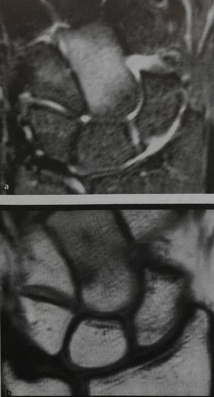 Снимки МРТ и КТ. Остеоид остеома