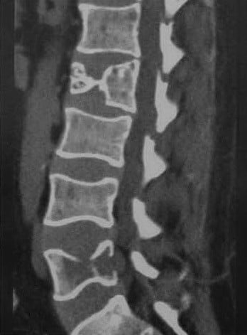 Снимки МРТ и КТ. Неопластический компрессионный перелом позвоночник