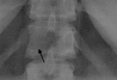 Снимки МРТ и КТ. Метастазы в кость