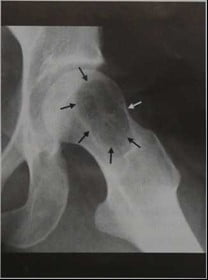 Снимки МРТ и КТ. Ювенильная костная киста