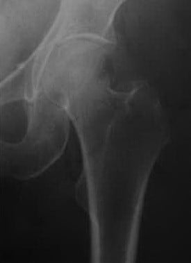 Снимки МРТ и КТ. Перелом шейки бедренной кости