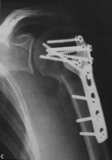 Снимки МРТ и КТ. Перелом проксимальной части плечевой кости