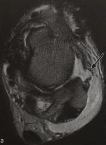 Снимки МРТ и КТ. Разрыв латеральной связки голеностопного сустава