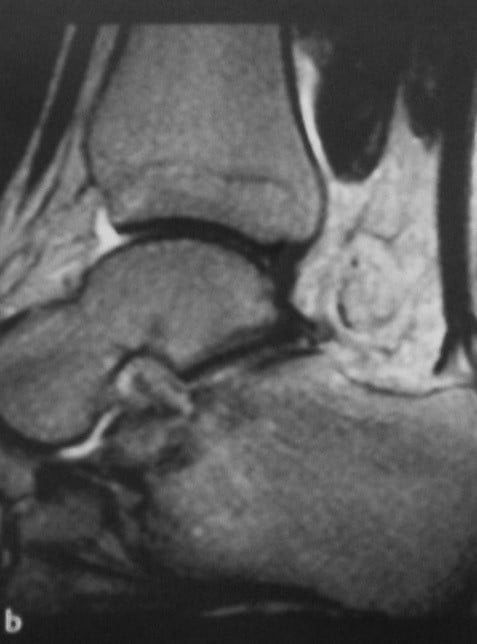 Снимки МРТ и КТ. Разрыв ахиллова сухожилия