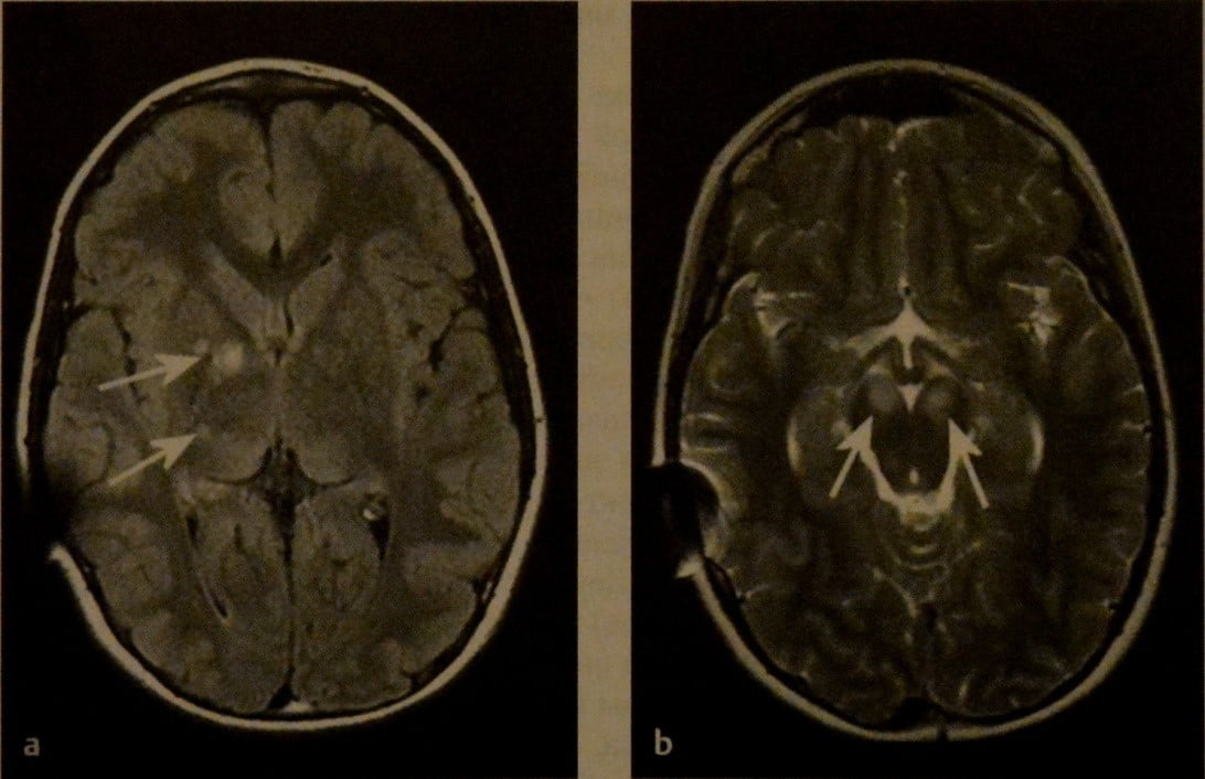 Снимки МРТ и КТ. Нейрокожный синдром у детей