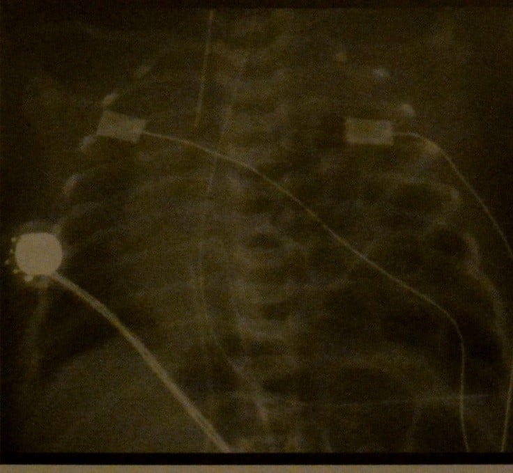 Снимки МРТ и КТ. Врожденная диафрагмальная грыжа