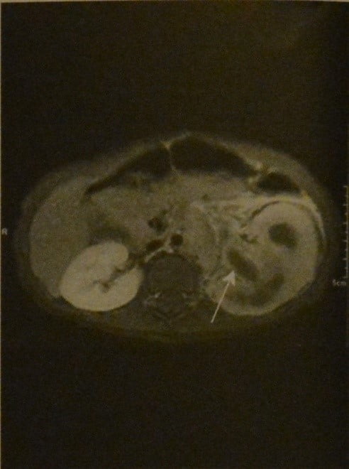 Снимки МРТ и КТ. Острый пиелонефрит