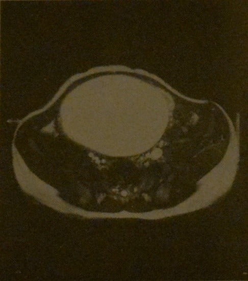 Снимки МРТ и КТ. Тератома яичника у ребенка