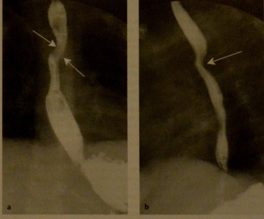 Снимки МРТ и КТ. Двойная дуга аорты