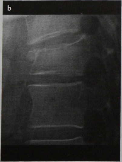 Снимки МРТ и КТ. Оскольчатый перелом позвоночника