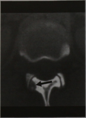 Снимки МРТ и КТ. Остеоид-остеома