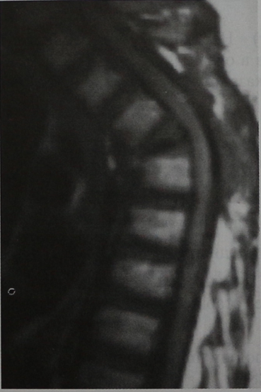 Снимки МРТ и КТ. Гистиоцитоз из клеток Лангерганса