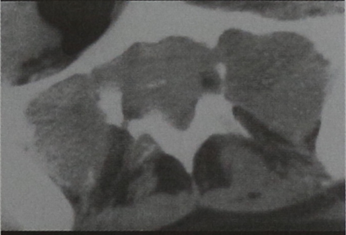 Снимки МРТ и КТ. Гигантоклеточная опухоль