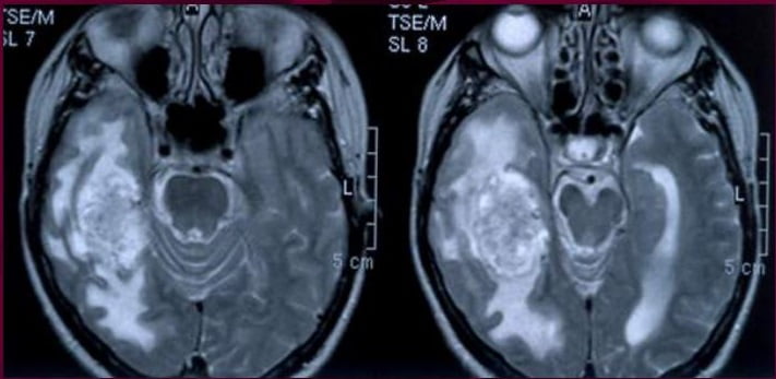 Снимки МРТ и КТ. Эпендимома головного мозга