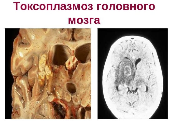 Снимки МРТ и КТ. Токсоплазмоз