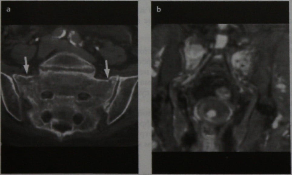 Снимки МРТ и КТ. Перелом крестца из-за снижения прочности кости
