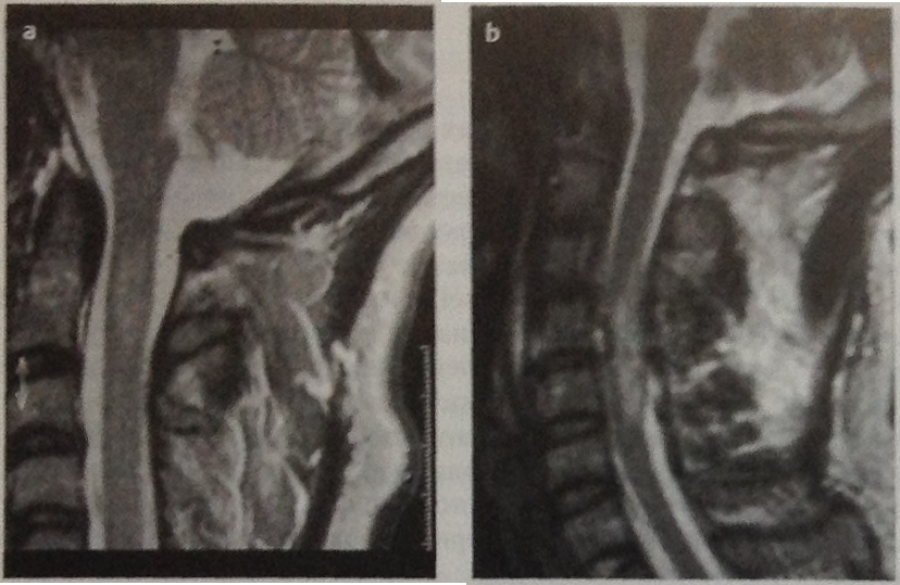 Снимки МРТ и КТ. Травмы спинного мозга