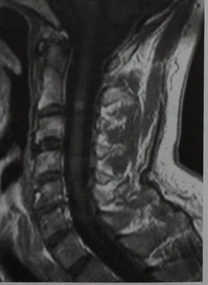 Снимки МРТ и КТ. Гранулематозное воспаление спинного мозга
