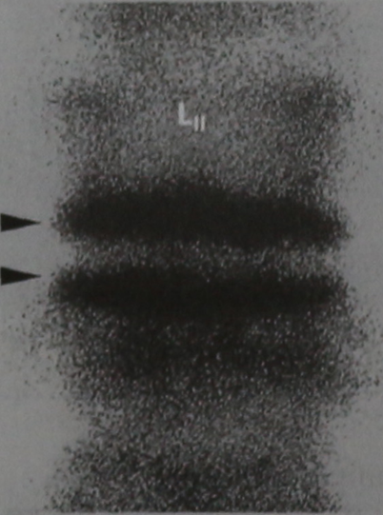 Снимки МРТ и КТ. Острый бактериальный спондилит
