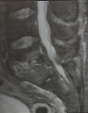 Снимки МРТ и КТ. Острый бактериальный спондилит
