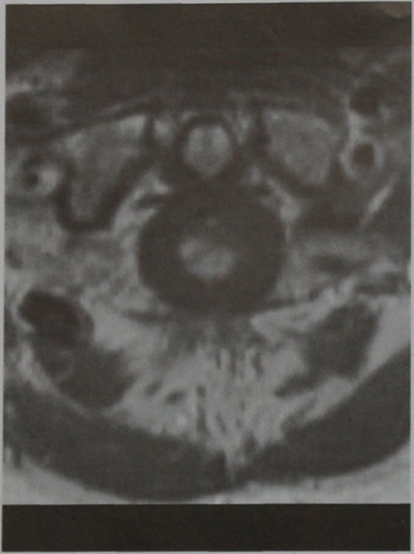 Снимки МРТ и КТ. Острый поперечный миелит