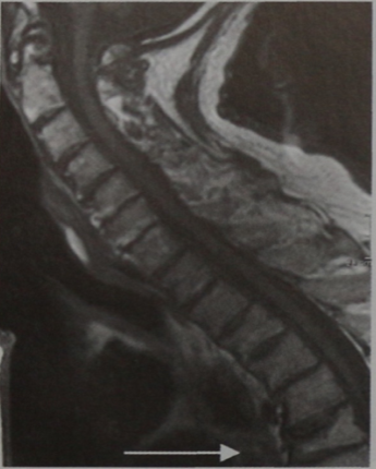 Снимки МРТ и КТ. Ревматоидный артрит хроническая травма